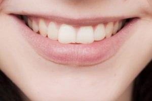 Questions about Invisalign