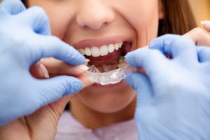 Invisalign in San Fernando Valley