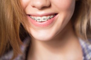 cost of Sherman Oaks braces