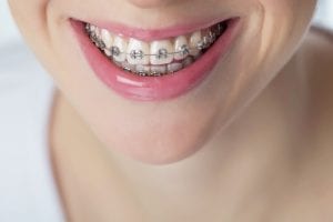 Braces in Calabasas