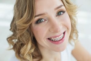 Learn Your Options for Braces in Calabasas
