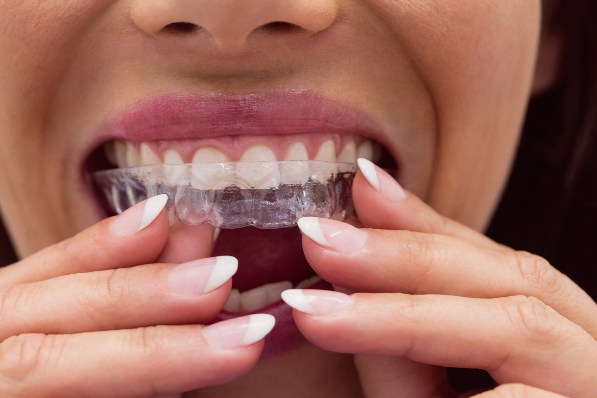 Northridge Invisalign is easy to take on and off!