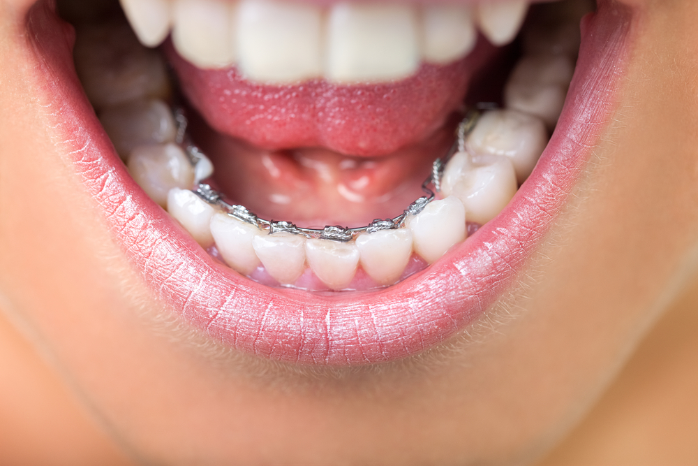 lingual braces winnetka