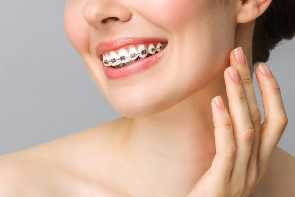 Adult Braces in Tarzana