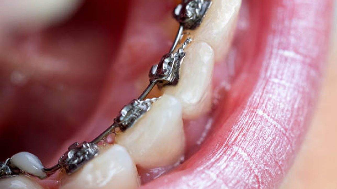 What are Invisible Lingual Braces?
