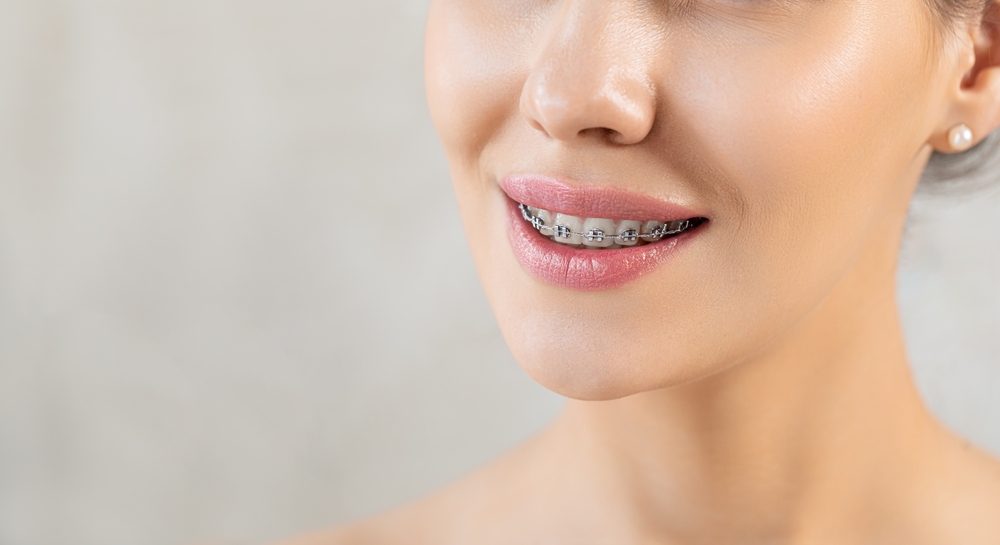 adult orthodontic treatments