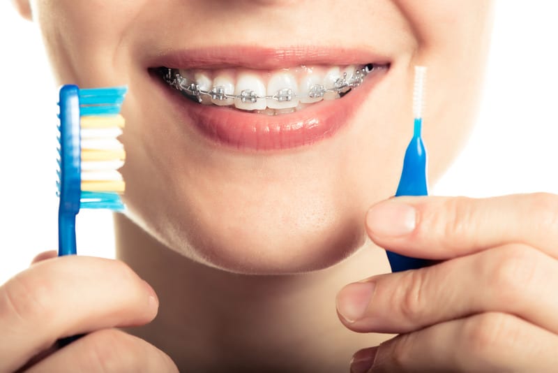 How to Care For Your New Braces The Right Way