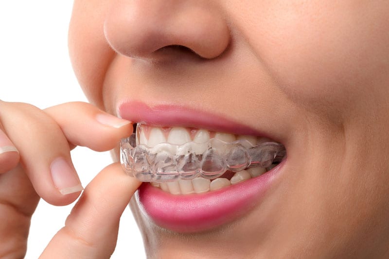 Studio City Invisalign