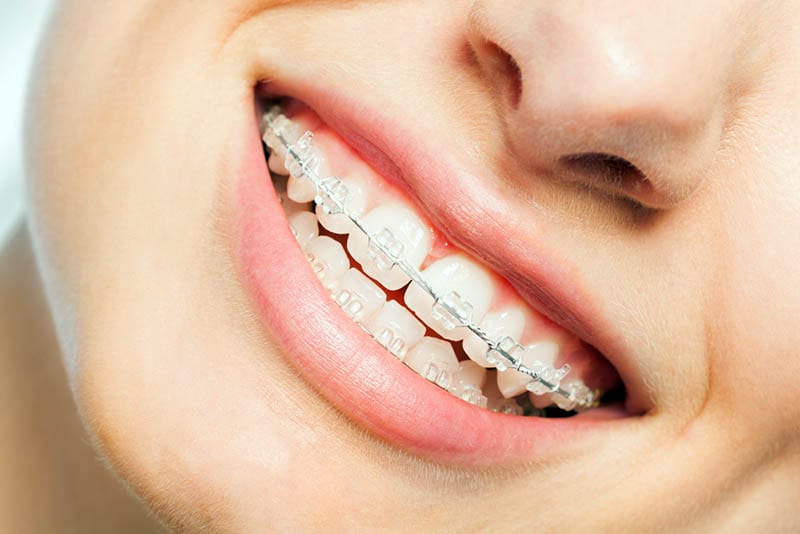 Different Types of Braces