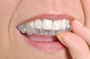 Where to Go for Reseda Invisalign Braces