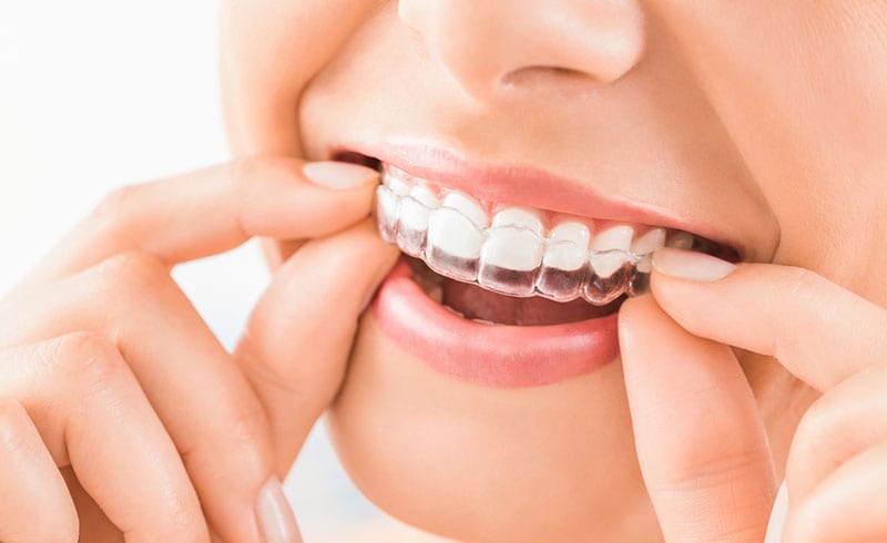 Costs of Invisalign in Studio City